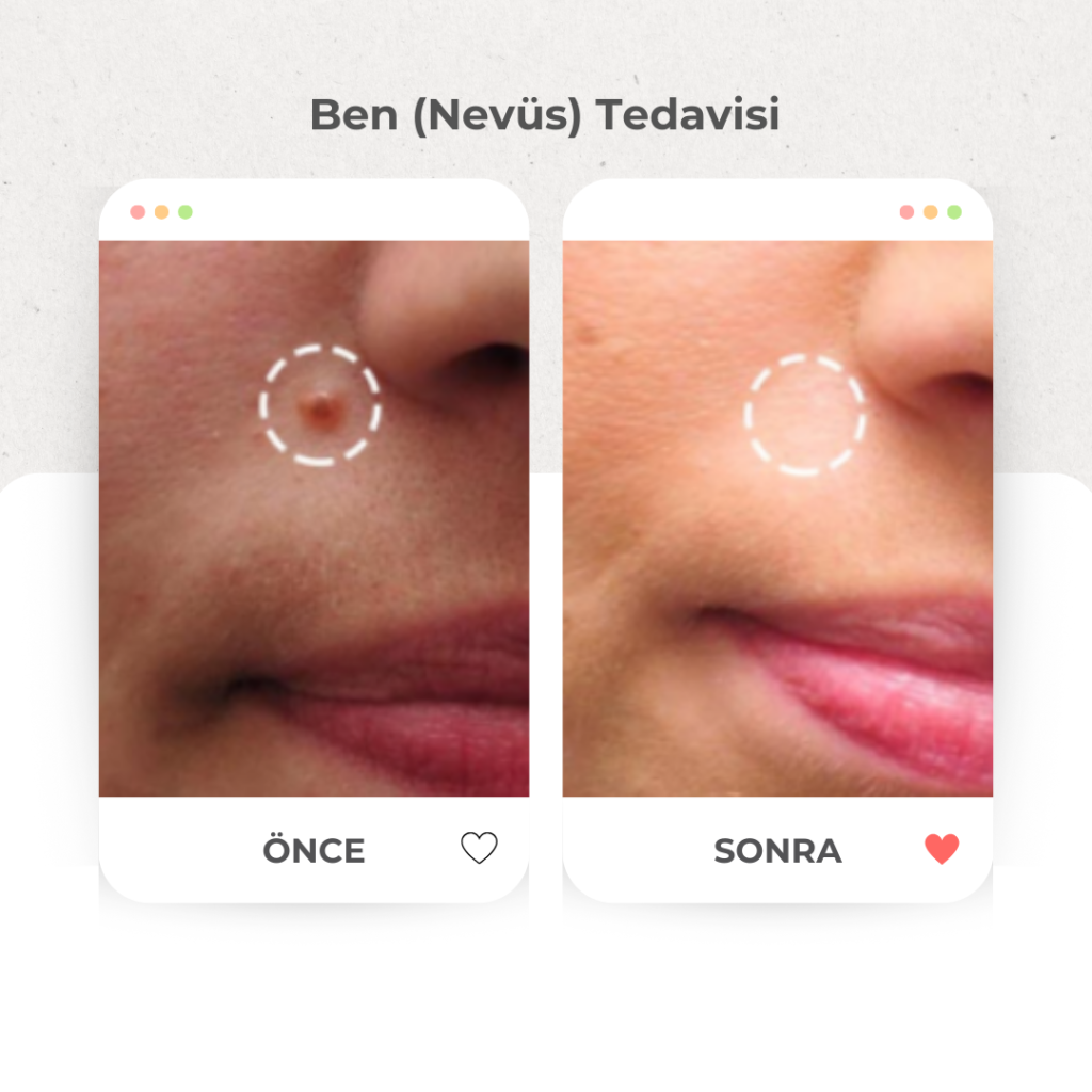 Ben (Nevüs) Tedavisi