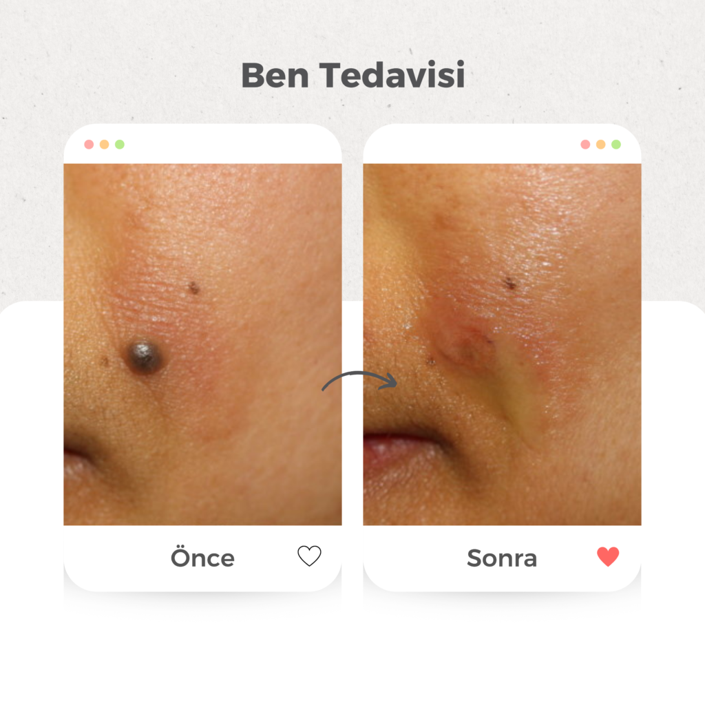 Ben (Nevüs) Tedavisi