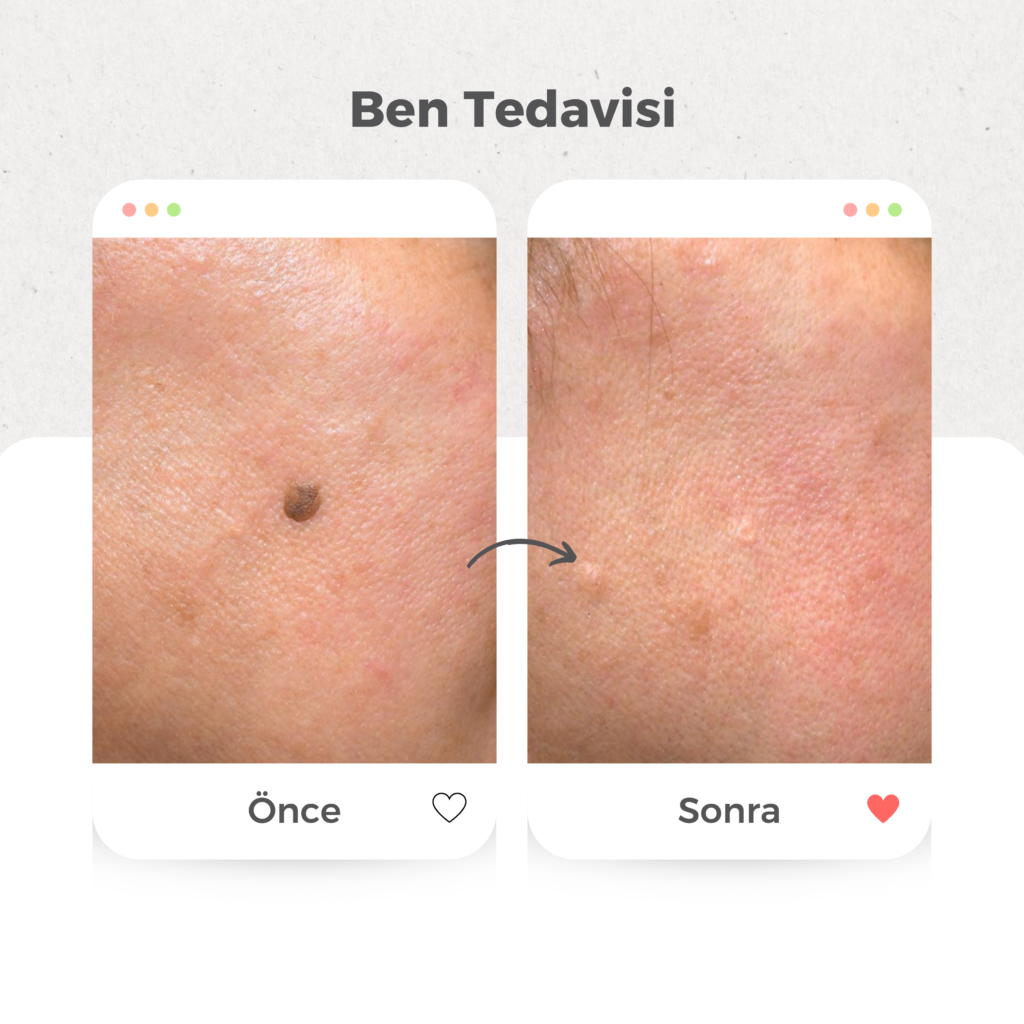 Ben (Nevüs) Tedavisi