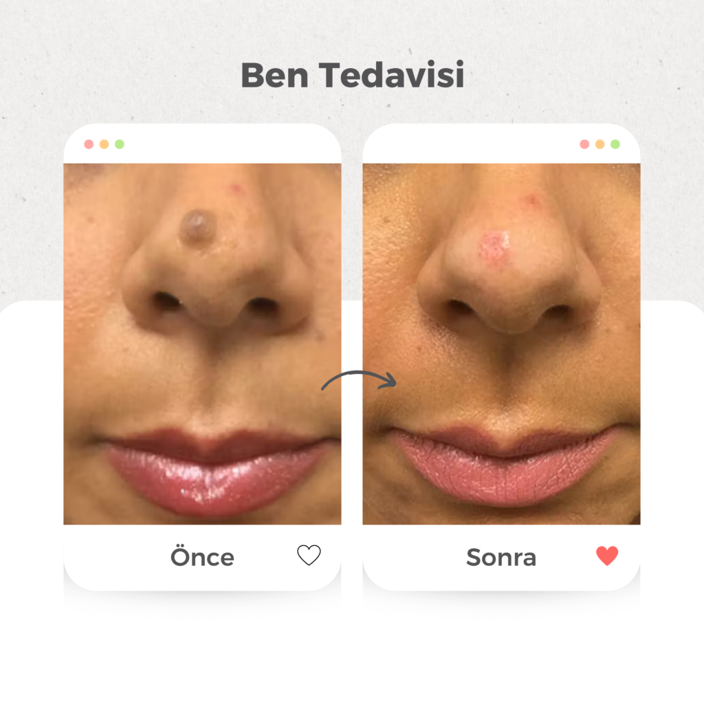 Ben (Nevüs) Tedavisi