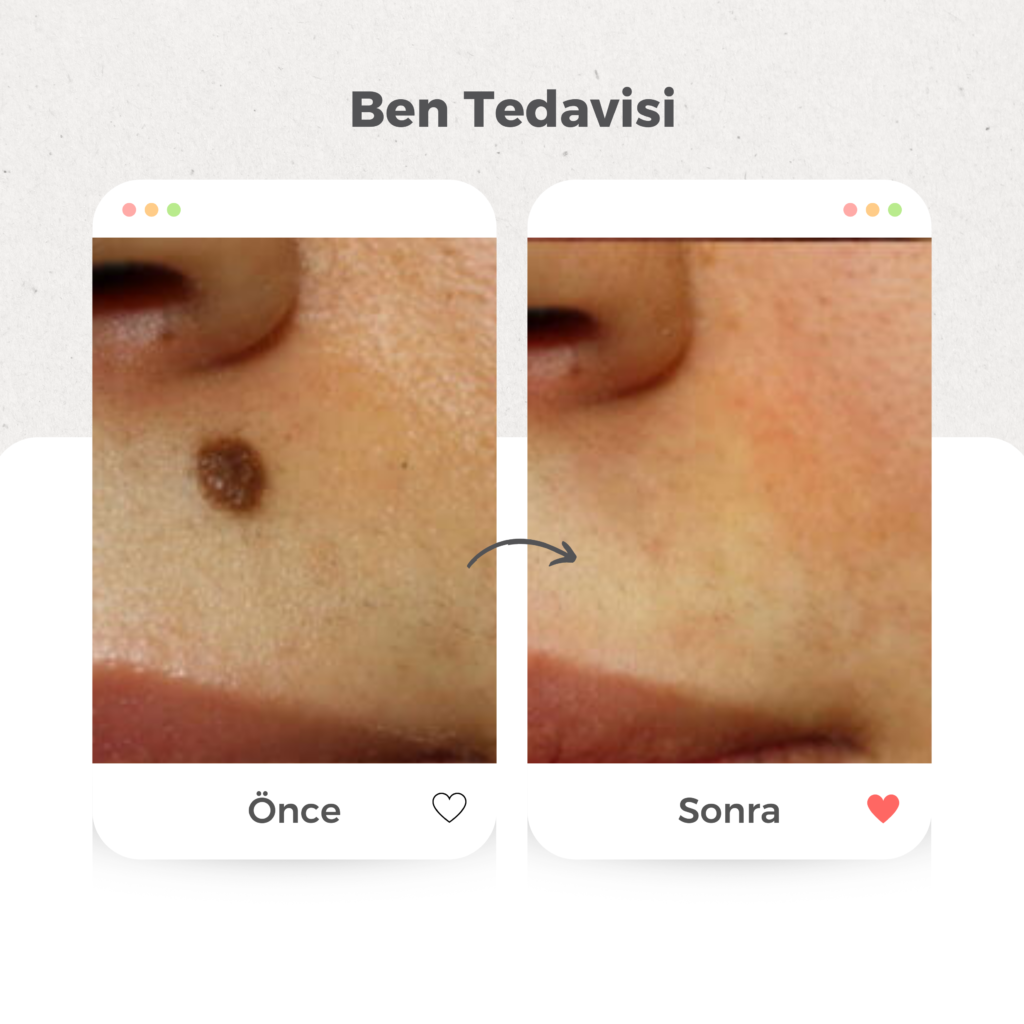 Ben (Nevüs) Tedavisi