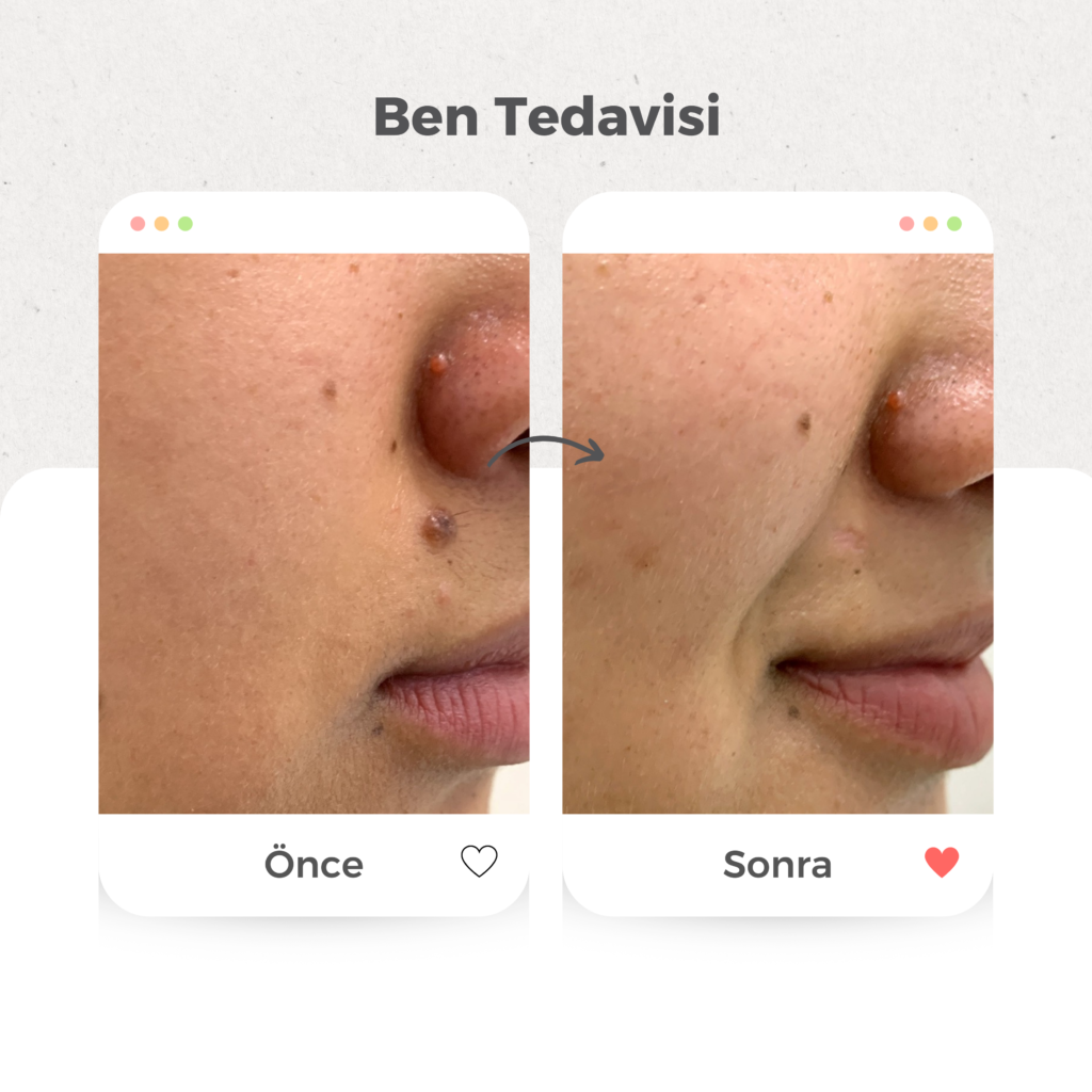 Ben (Nevüs) Tedavisi
