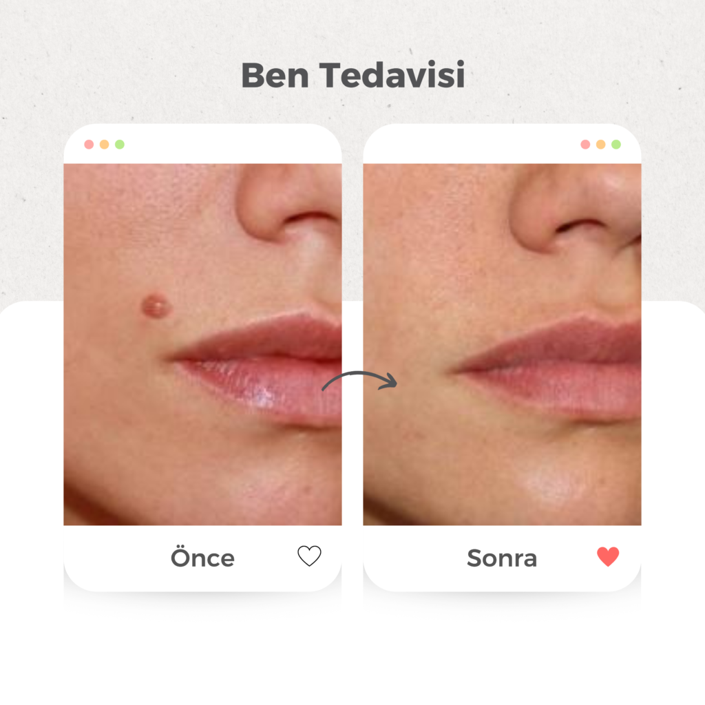 Ben (Nevüs) Tedavisi