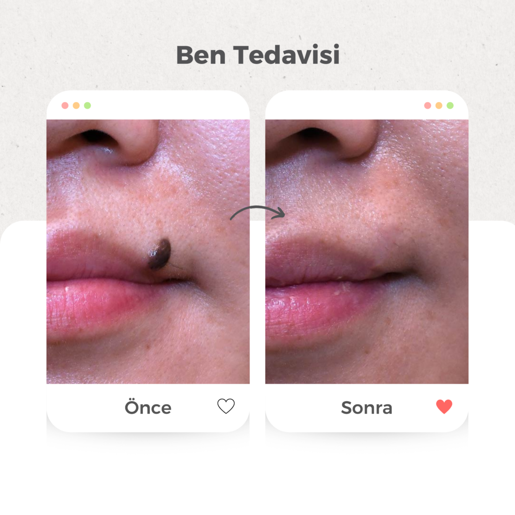 Ben (Nevüs) Tedavisi