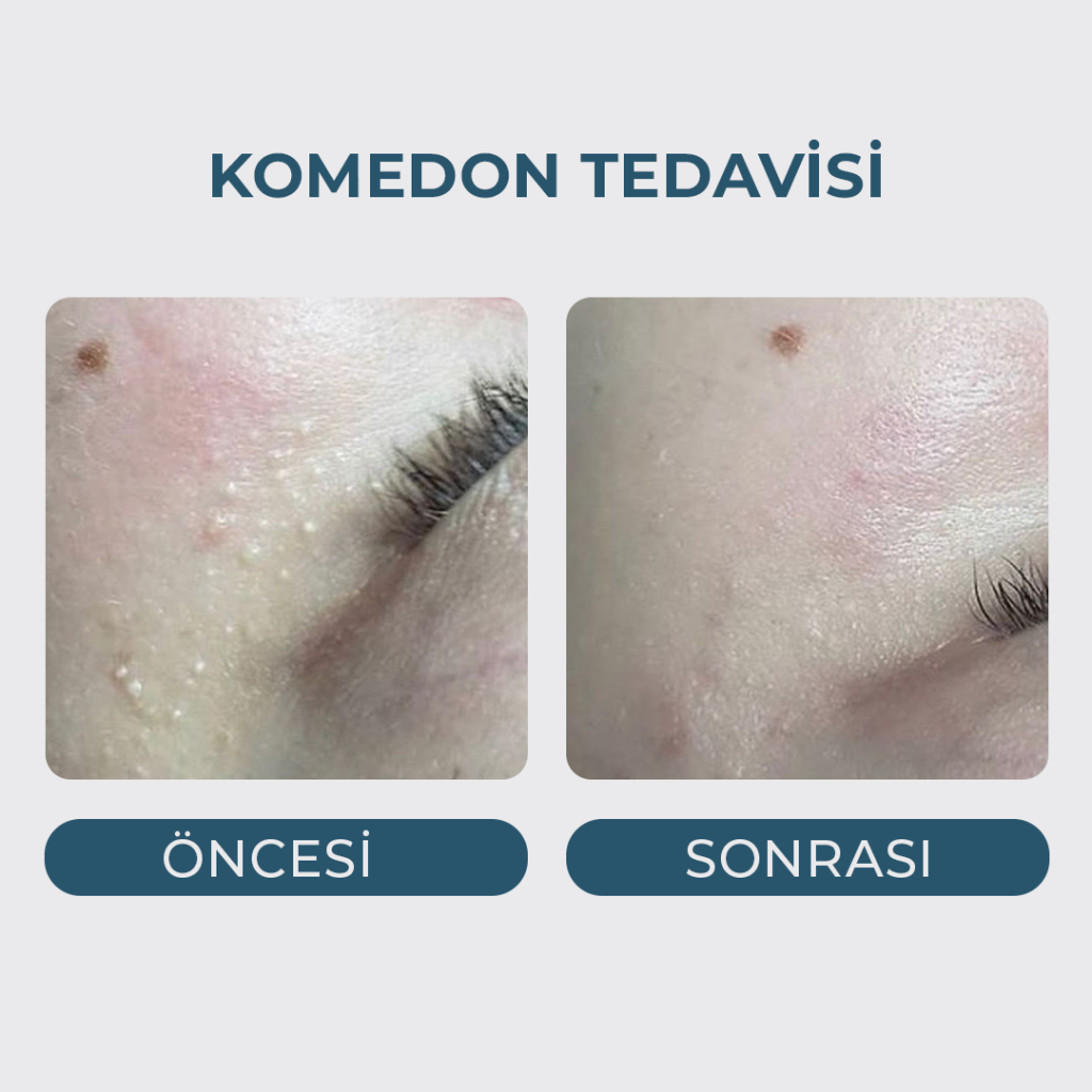 Yağ Bezesi (Komedon Milia) Tedavisi