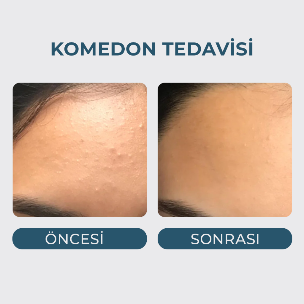 Yağ Bezesi (Komedon Milia) Tedavisi