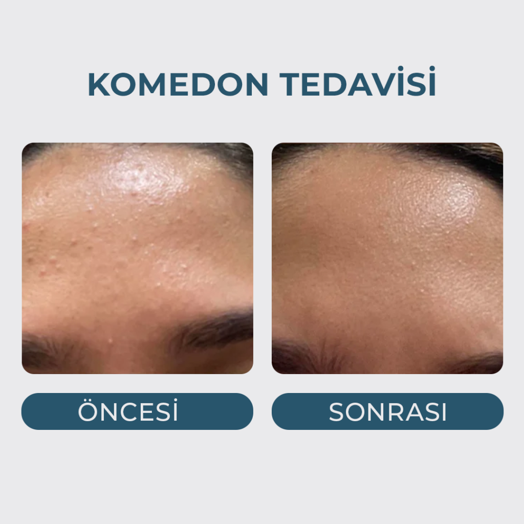 Yağ Bezesi (Komedon Milia) Tedavisi