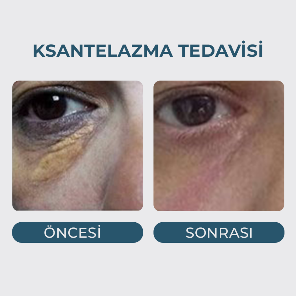Yağ Bezesi (Ksantelazma) Tedavisi