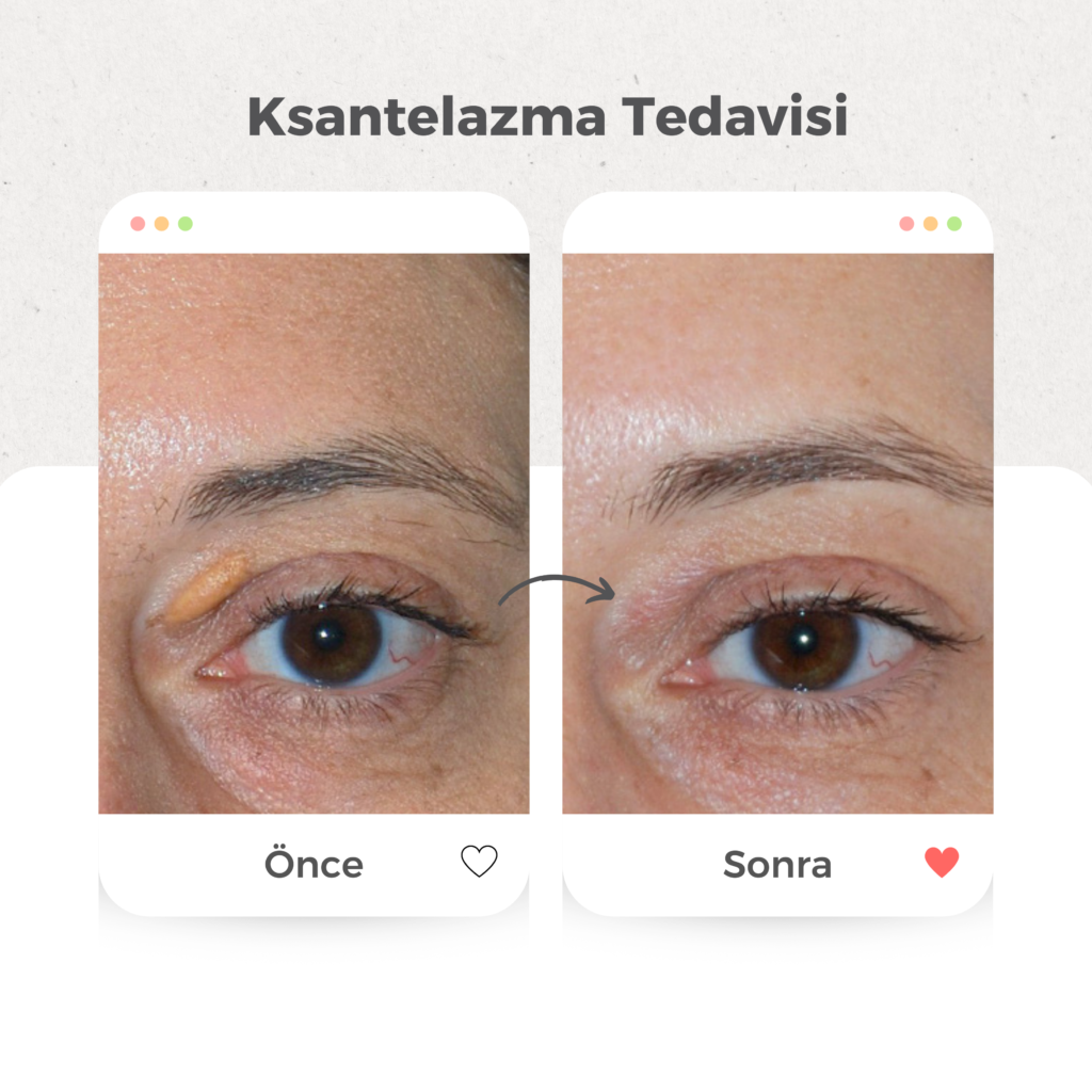Yağ Bezesi (Ksantelazma) Tedavisi
