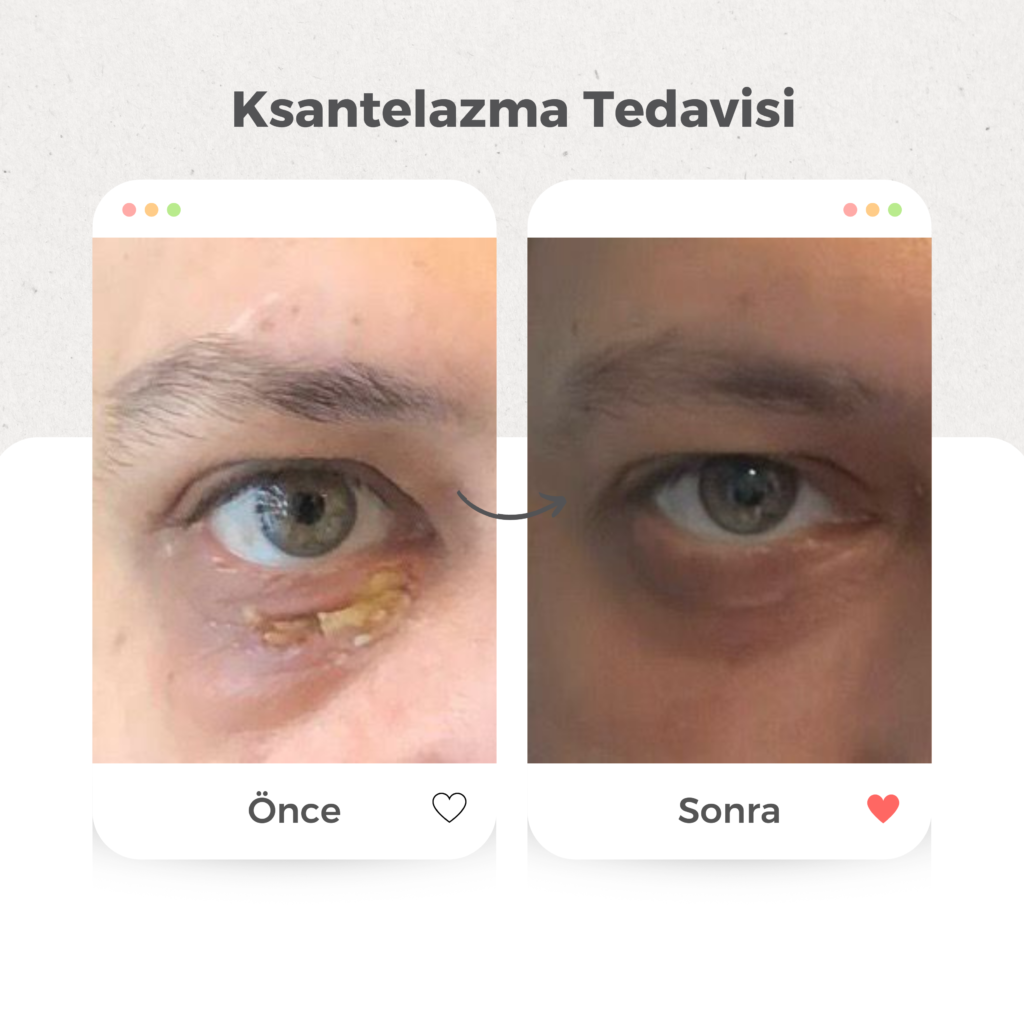 Yağ Bezesi (Ksantelazma) Tedavisi