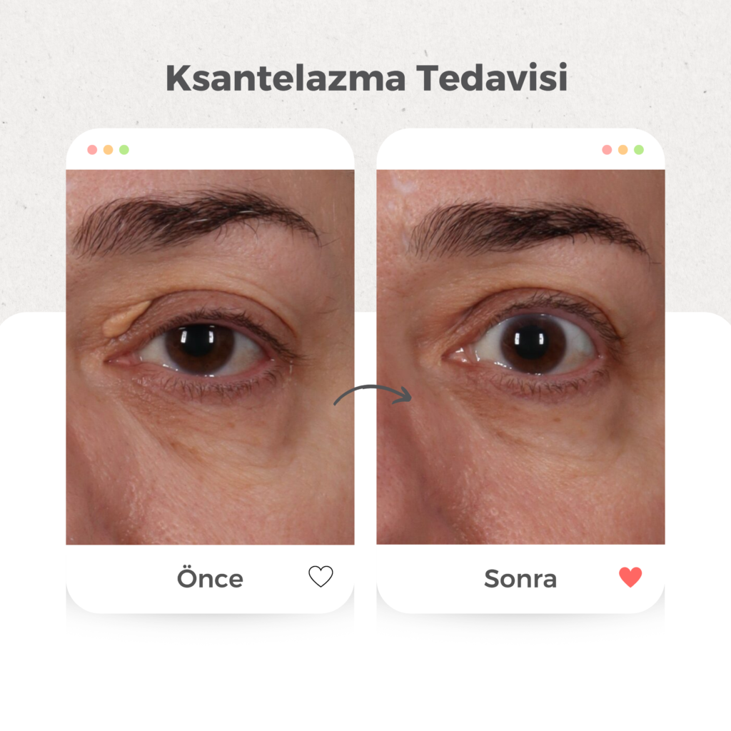 Yağ Bezesi (Ksantelazma) Tedavisi