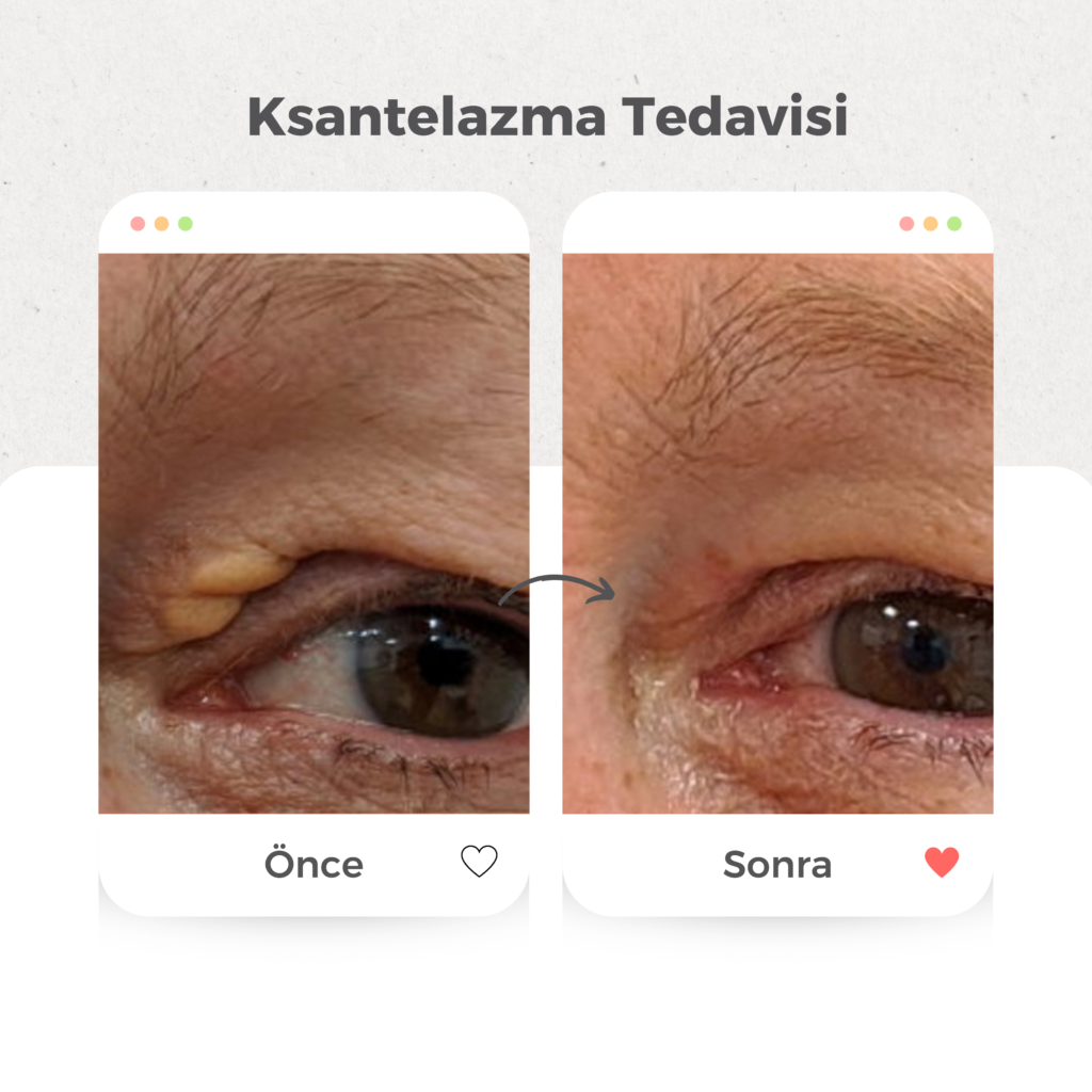 Yağ Bezesi (Ksantelazma) Tedavisi