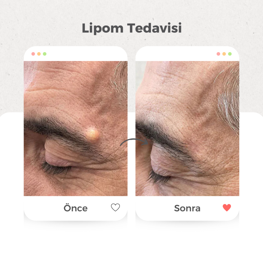 Yağ Bezesi (Lipom) Tedavisi