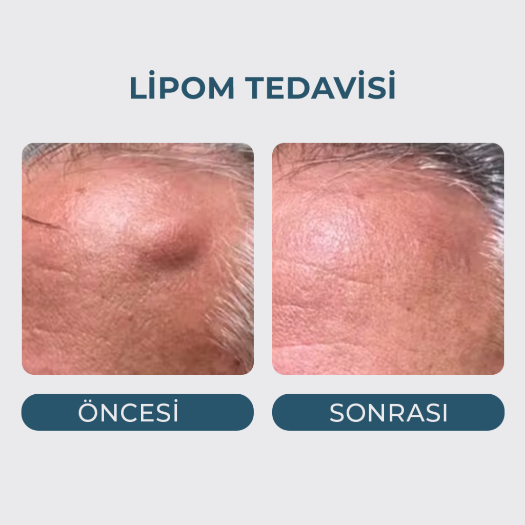 Yağ Bezesi (Lipom) Tedavisi