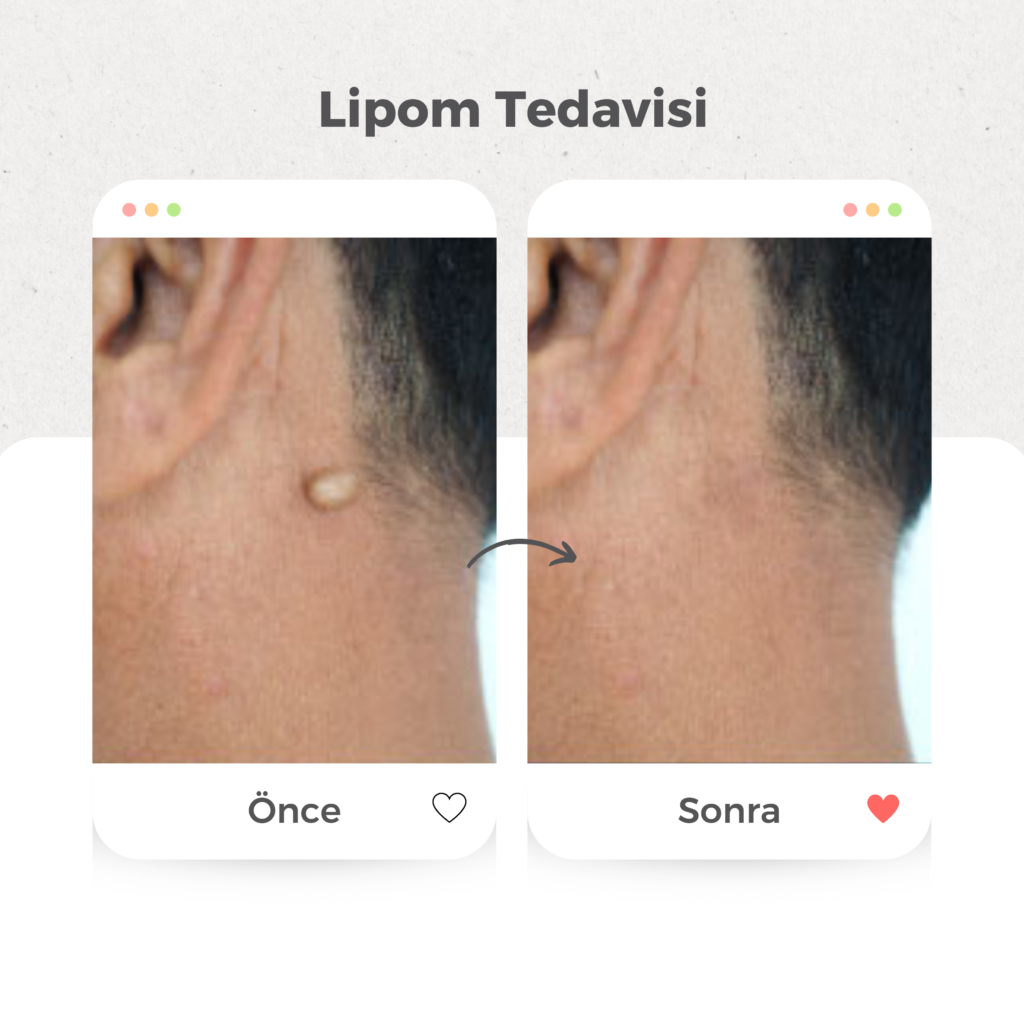 Yağ Bezesi (Lipom) Tedavisi