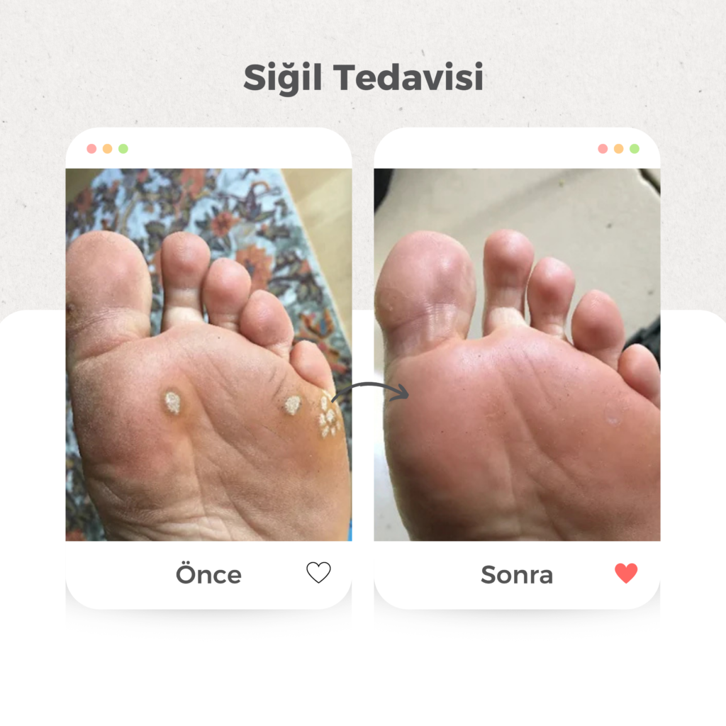 Siğil Tedavisi