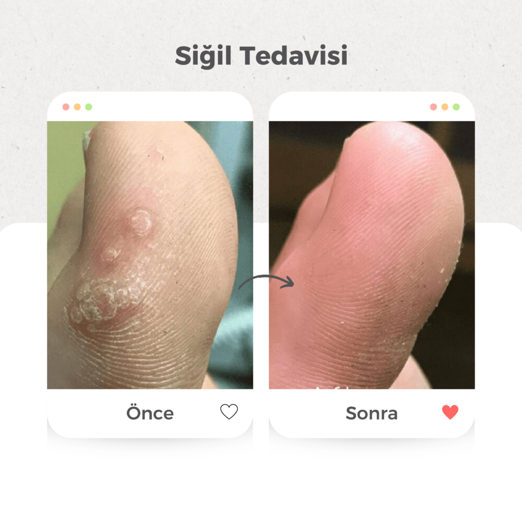 Siğil Tedavisi