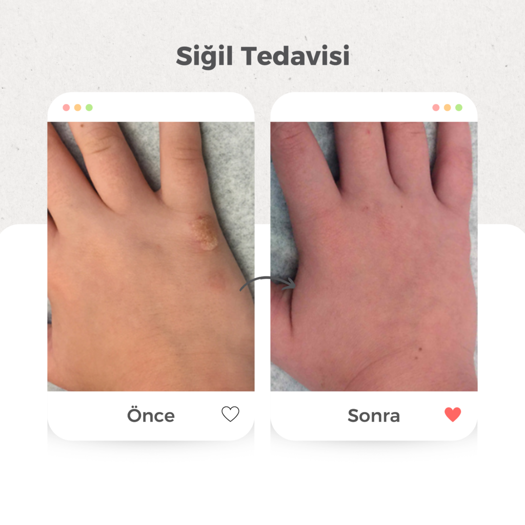Siğil Tedavisi