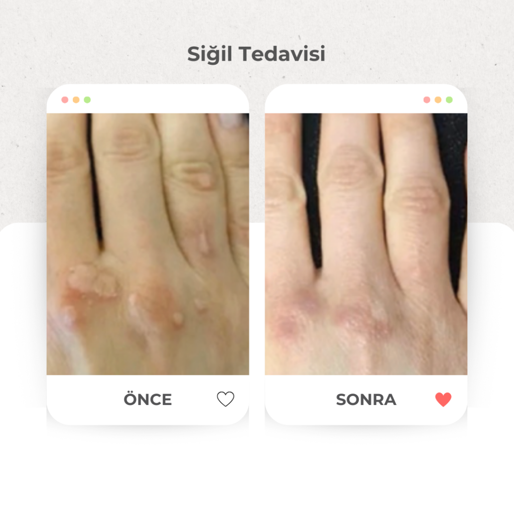 Siğil Tedavisi