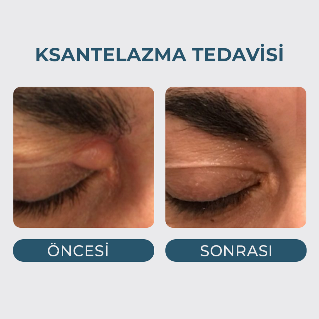 Yağ Bezesi (Ksantelazma) Tedavisi