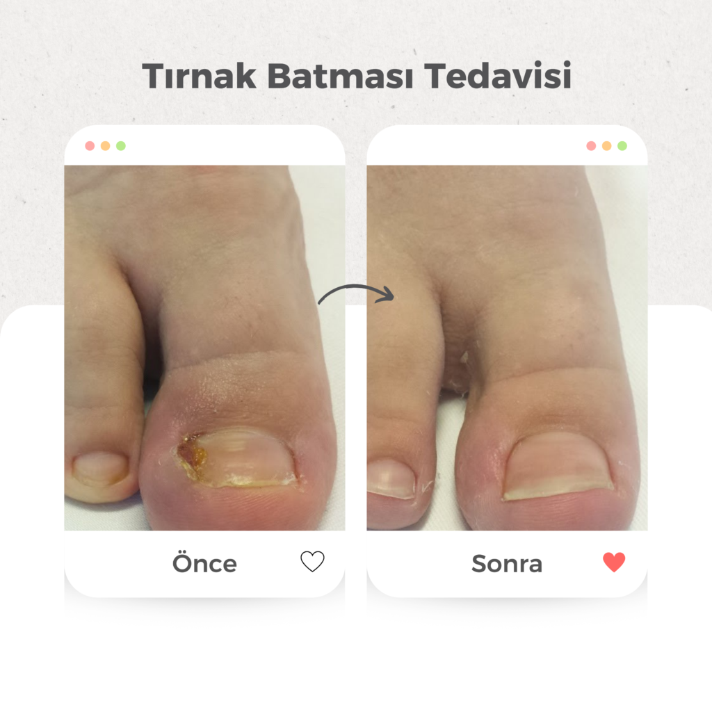 Tırnak Batması