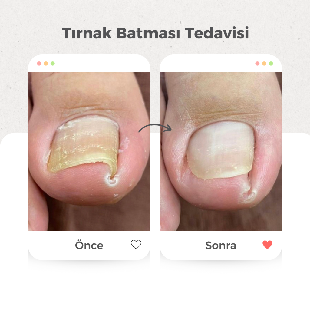 Tırnak Batması