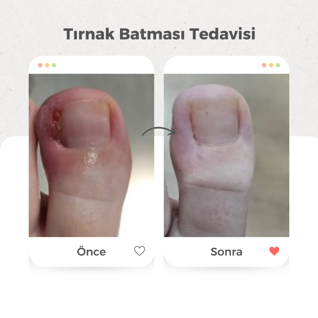Tırnak Batması